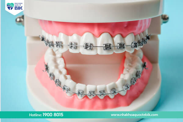 Advantages of conventional metal braces