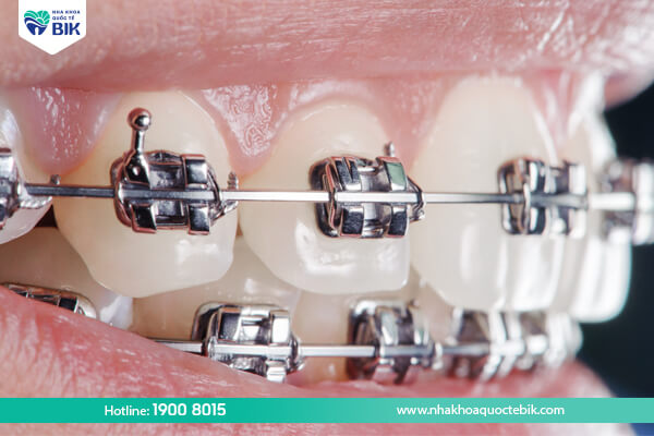 Disadvantages of conventional metal braces