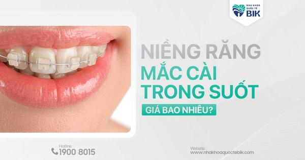 Niềng Răng Mắc Cài Trong Suốt Giá Bao Nhiêu?