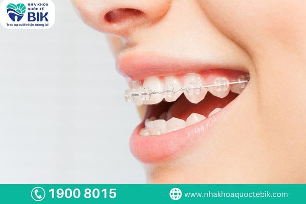 Introduction to clear braces