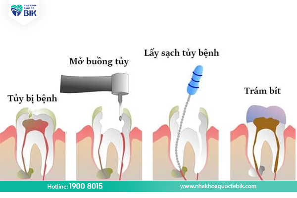 What is the process of root canal treatment?