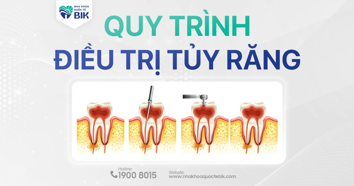 Quy trình điều trị tủy răng