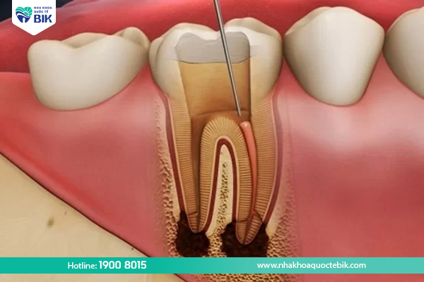 Why is root canal treatment needed?