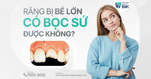 Răng Bị Bể Lớn Có Bọc Sứ Được Không?