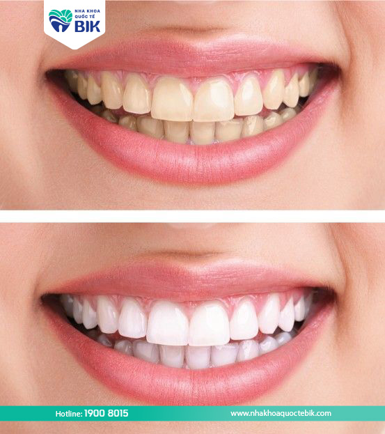 What is Katana porcelain teeth?