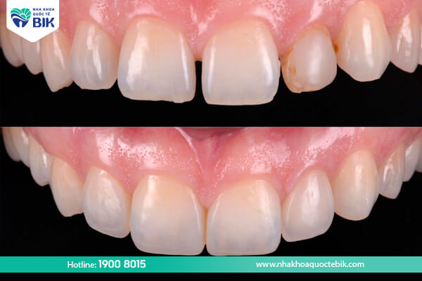 Porcelain crowns for spaced teeth