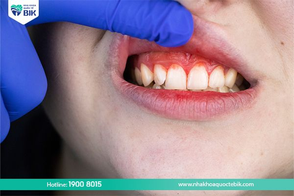 What is swollen gums?