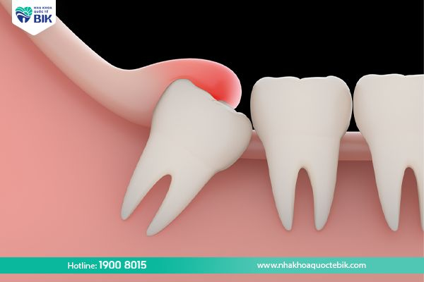  Swollen gums due to wisdom teeth 