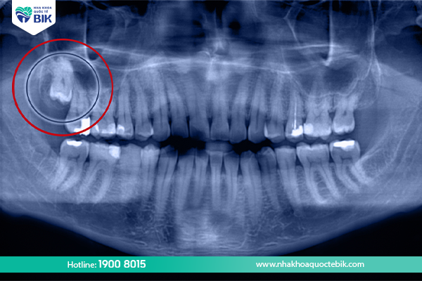 Swollen gums due to wisdom teeth