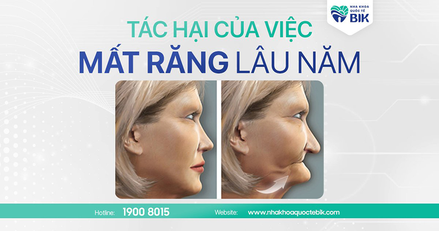 Tác hại của việc mất răng lâu năm mà bạn nên biết