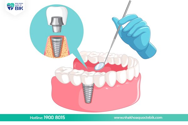 How long is the lifespan of Implant teeth?