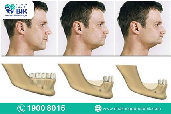 Prevent jaw bone loss