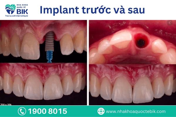 Notes after Korean dental implant surgery