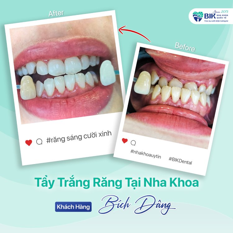 Khách hàng tẩy trắng răng Bích Dâng