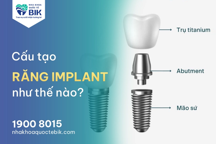 Cấu tạo răng Implant gồm những gì? Chi tiết từ A – Z